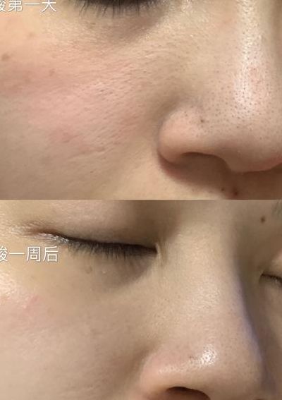 果酸换肤对比（果酸换肤对比前后）