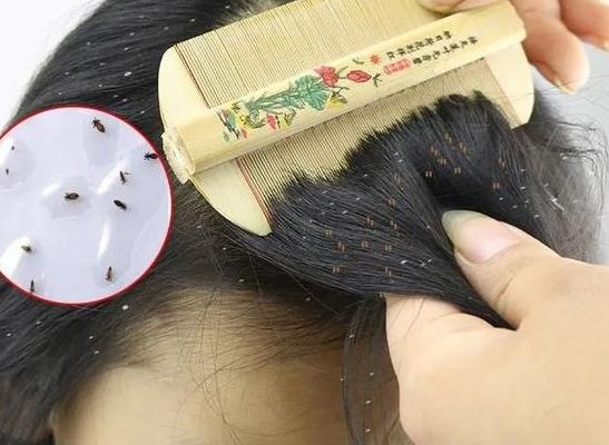 虱子怕什么（虱子怕什么 杀死虱子的方法）