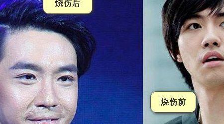 俞灏明为什么会烧伤（俞灏明为何烧伤）