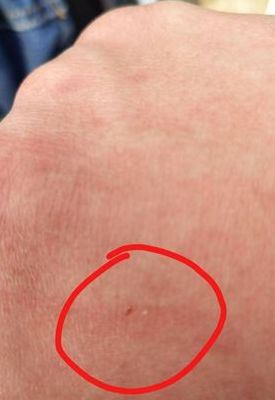 我家金毛把我弄到两次了(被别人家的大金毛用爪子抓破了一点皮，流血了。用打疫苗吗？)