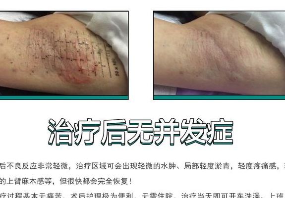 腋臭微波治疗费用（腋臭微波治疗能根治吗）