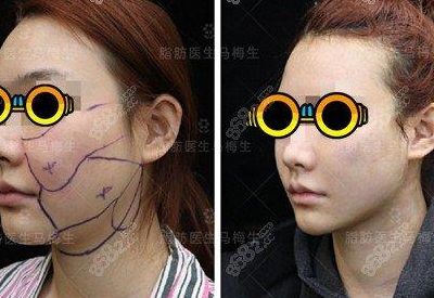 面部吸脂哪里好（面部吸脂哪里做比较好）