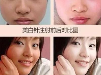 注射美白针哪里好（美白针去哪打最安全）