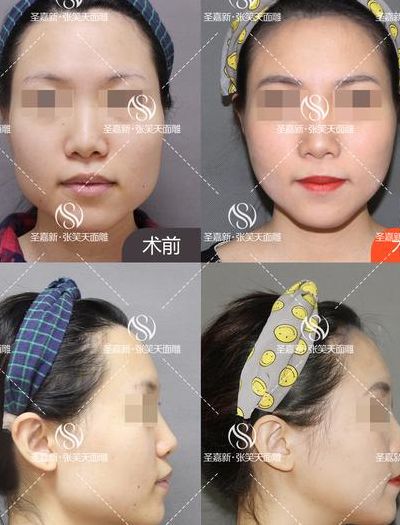 治疗下颌角肥胖（治疗下颌角肥胖的药物）