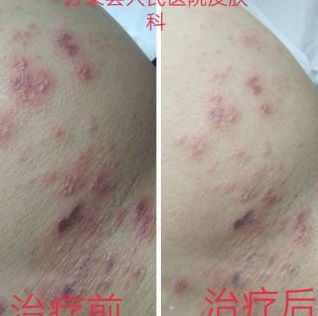 治疗皮肤科疾病（皮肤科治疗哪些疾病）