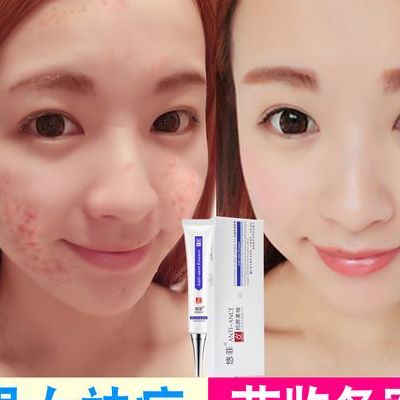 快速去痘痘产品（快速去痘痘产品有哪些）