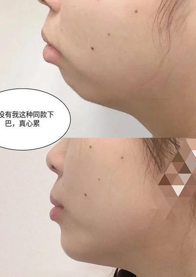 下巴短整形（下巴短矫正）