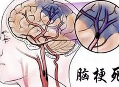 脑梗能治好吗（老年人脑梗能治好吗）