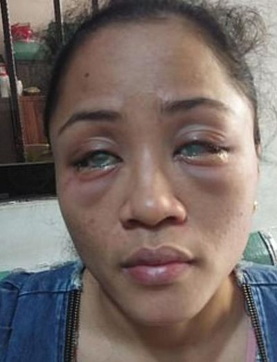 被泼硫酸怎么处理（被泼硫酸的应急处理）