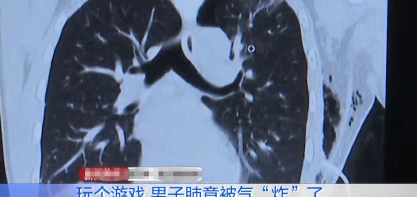 打游戏连输肺气炸（打游戏被气然后呼吸困难胸闷）