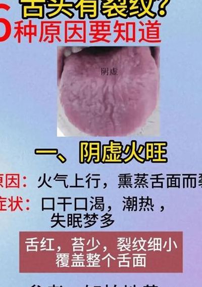 舌苔发白有裂纹是什么原因（舌苔发白有裂纹是什么原因引起的怎么解决）