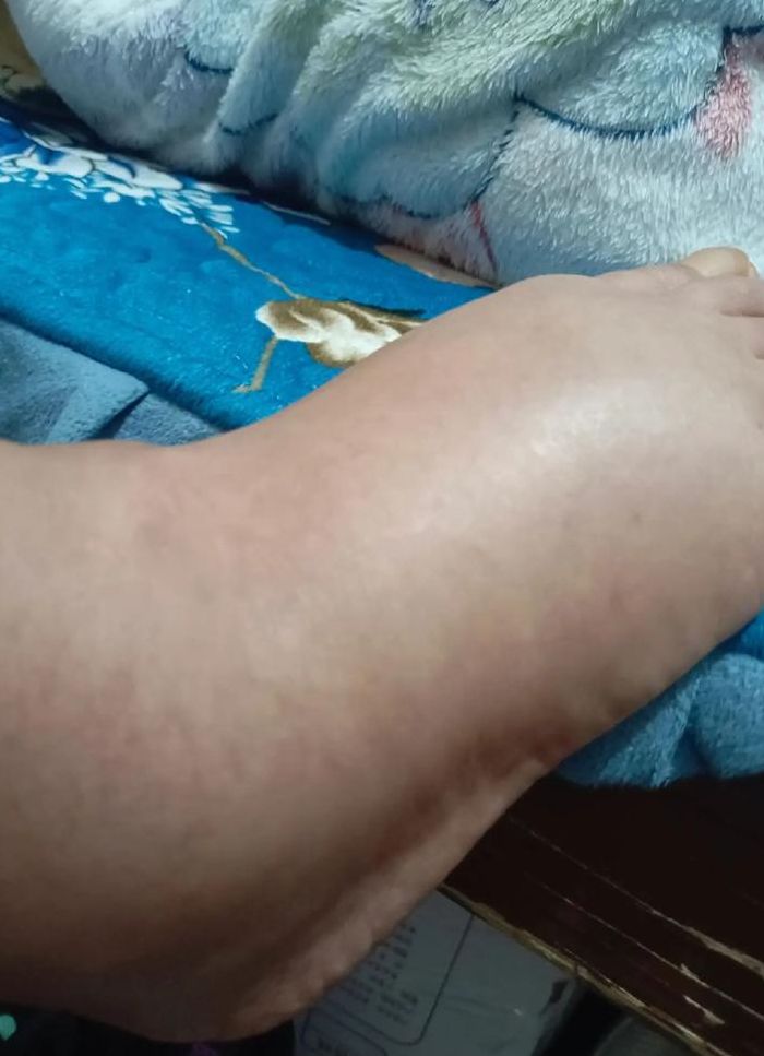 脚肿是怎么引起的（脚肿是怎么引起的会严重吗）