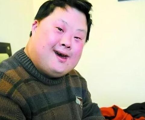 唐氏综合征脸图片（唐氏综合症典型面容图片）