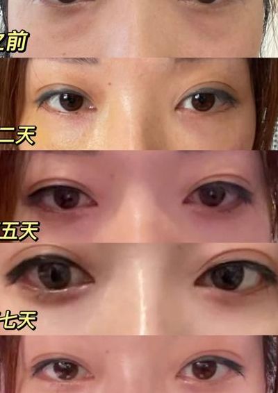 眼袋淤青怎么快速恢复（眼袋淤青怎么快速恢复吃什么药）