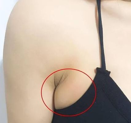 看腋窝应该挂什么科室（腋窝去医院挂什么科室）
