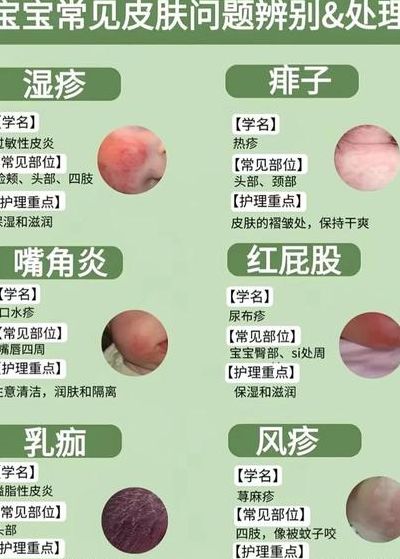 热痱子怎么消除小妙招（湿疹和热疹图片对照）
