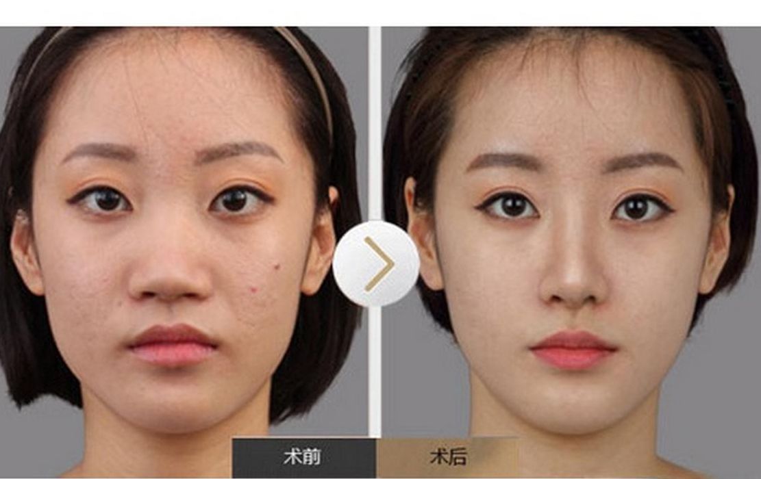 缩鼻头对照表图（缩鼻头前后图片）