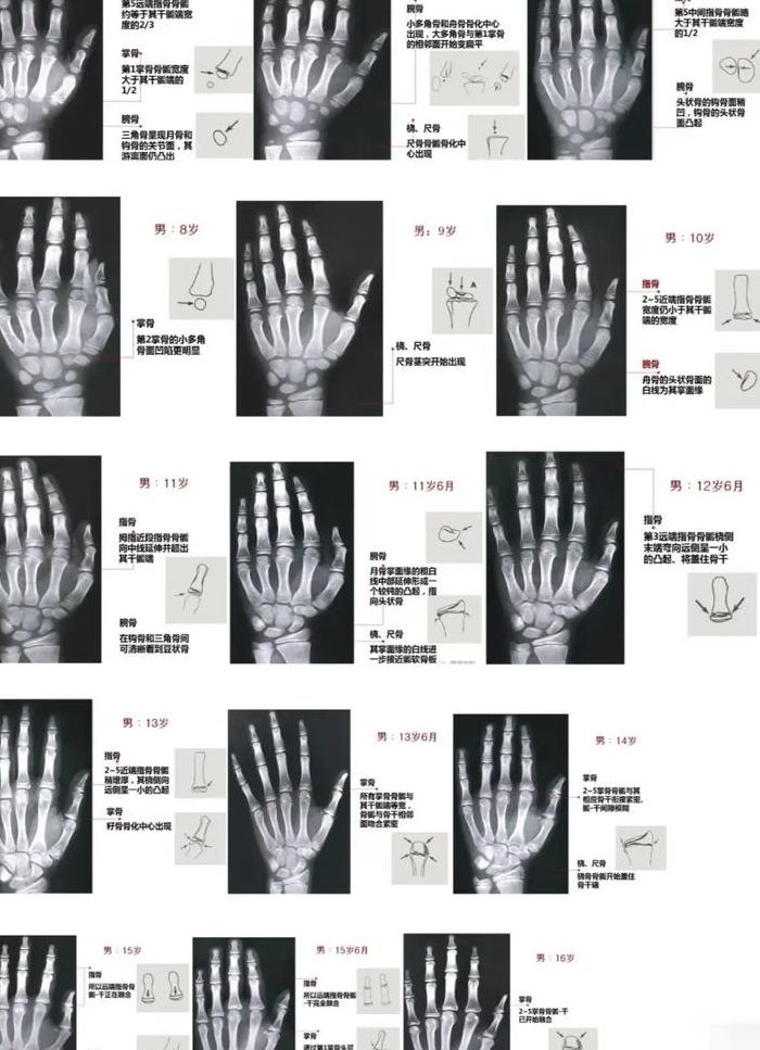 怎么看骨龄数据对照表图（骨龄报告如何看骨龄数）
