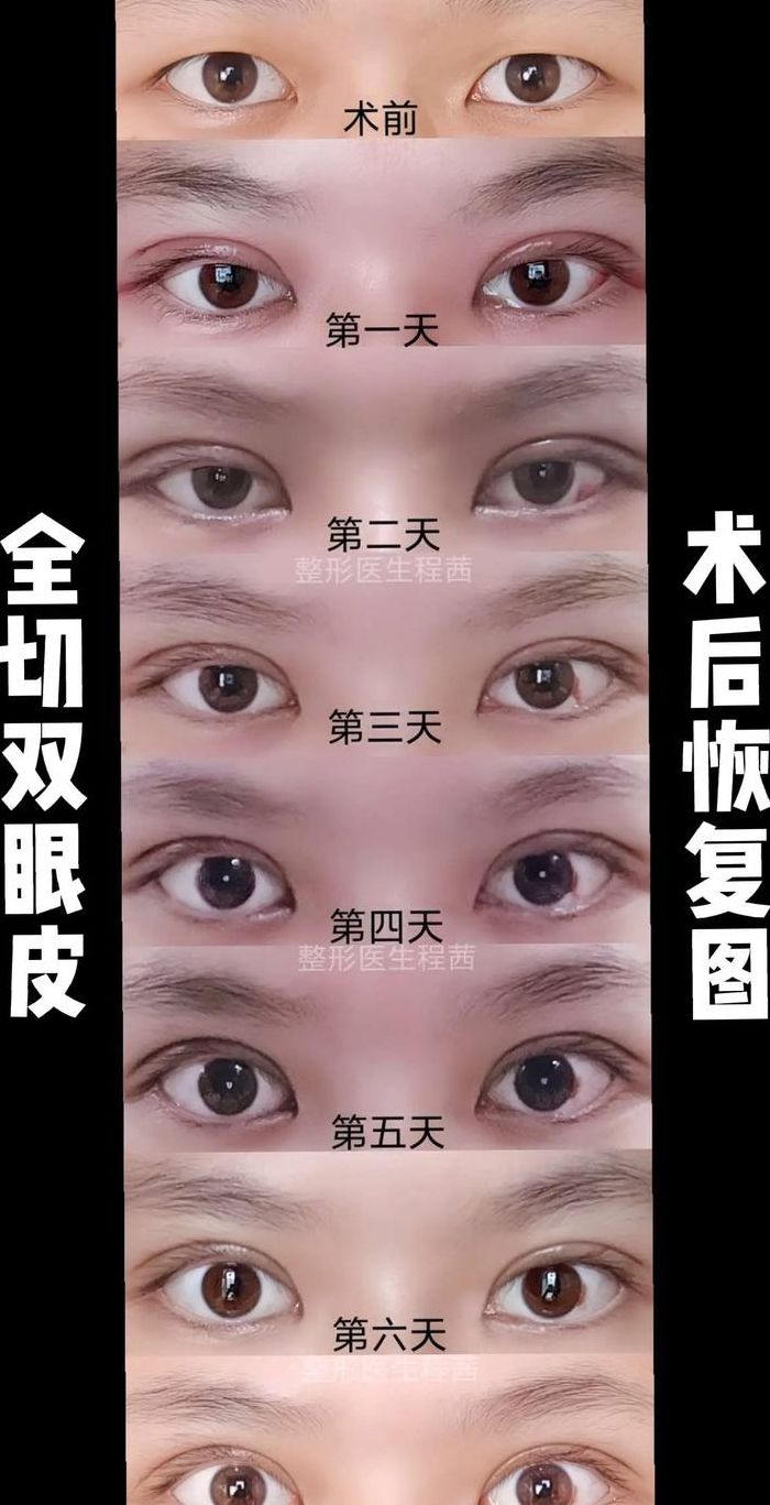 双眼皮全切年龄对照表图（双眼皮全切对比图）